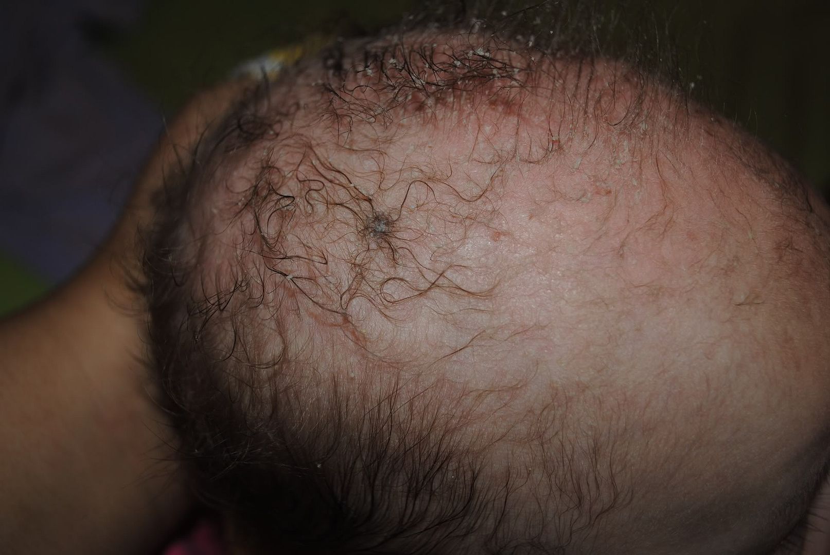 Cradle cap problems BabyGaga