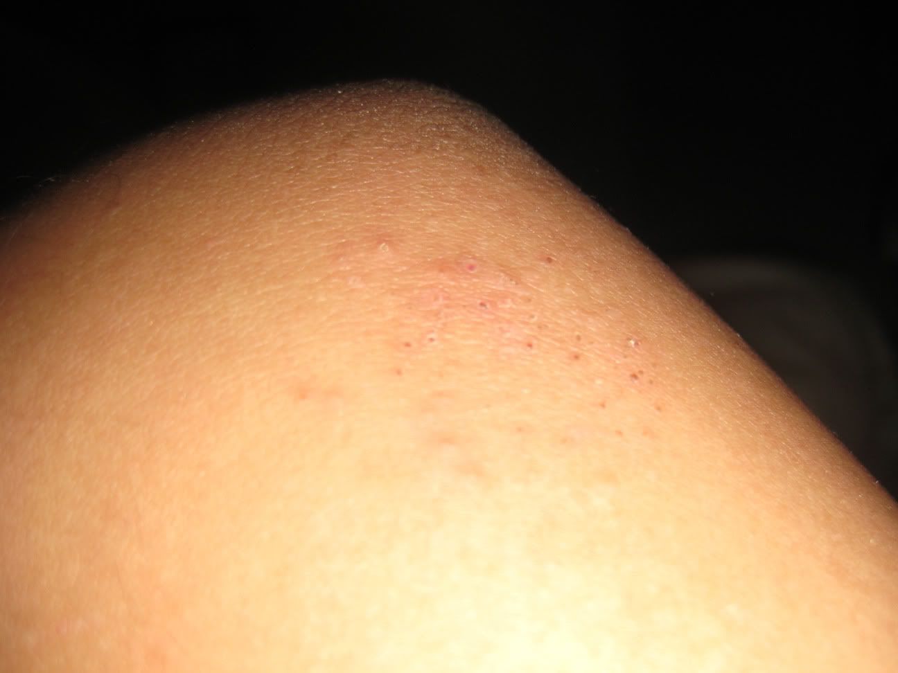 Why Do I Get Little Bumps On My Arms And Legs