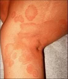 How to get rid of ringworm - Ringworm In.